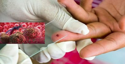 ম্যালেরিয়া রোগটি যেভাবে প্রাণঘাতী হয়ে উঠলো