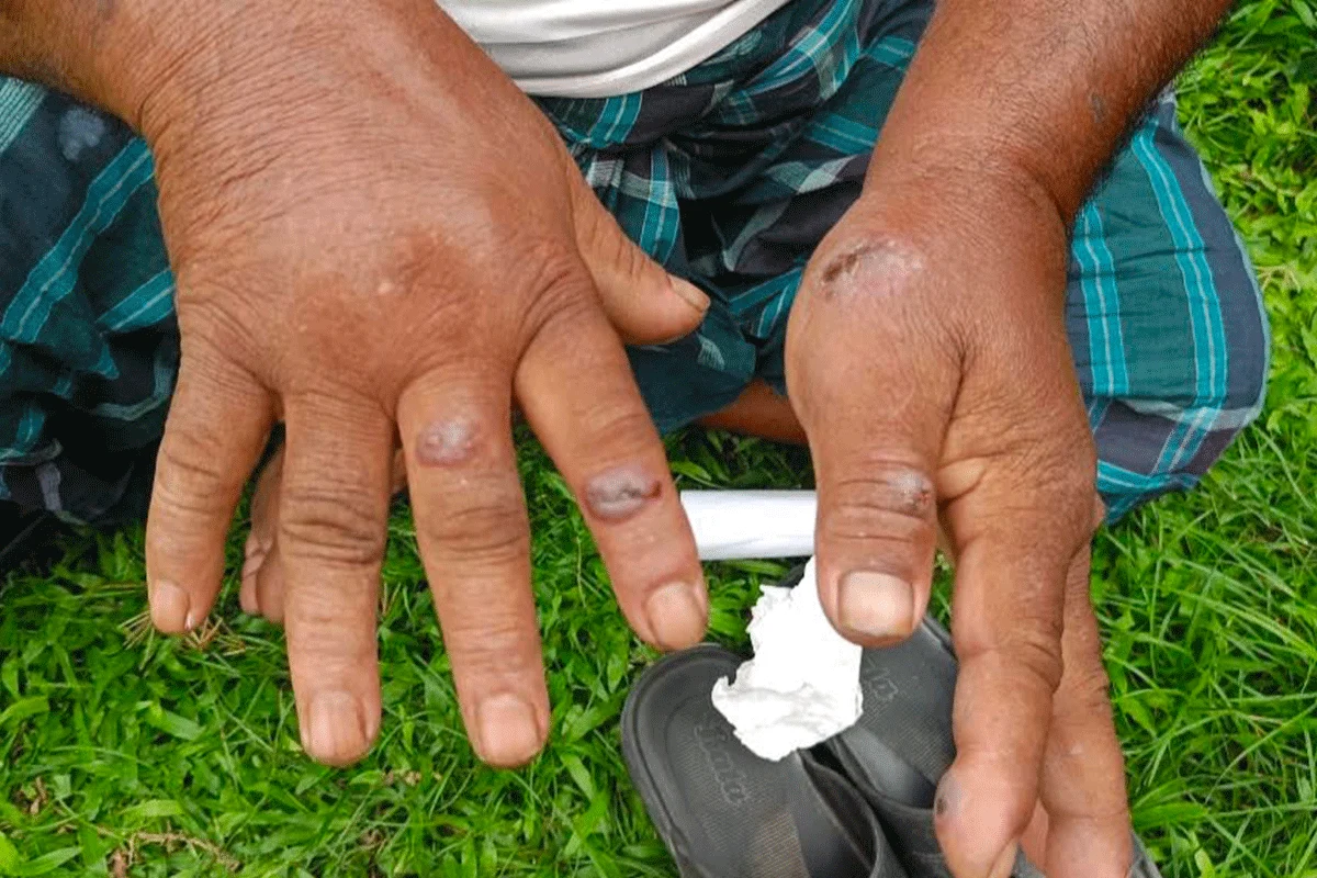 গাইবান্ধায় অ্যানথ্রাক্সে আক্রান্ত বেড়ে ৩৪